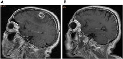 Case Report: Microglia Composition and Immune Response in an Immunocompetent Patient With an Intracranial Syphilitic Gumma